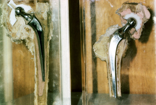 Figure 4  Two samples from autopsies. On the left, a Teflon acetabular cup worn out after some years of use. Note vertical&hellip;