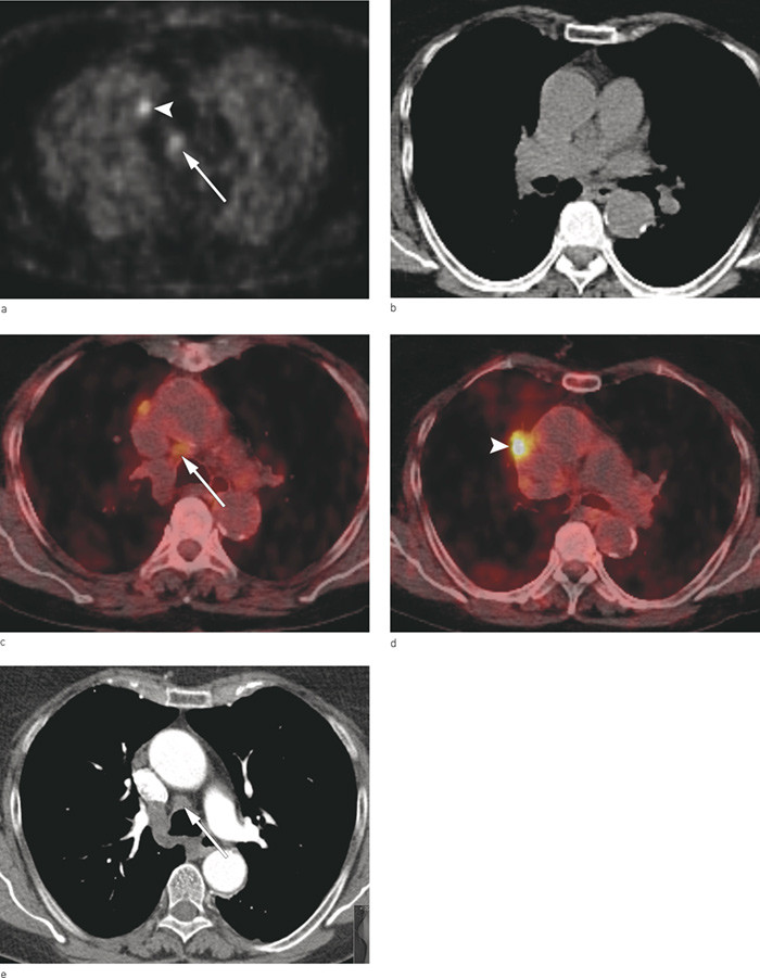 Figure 3a&thinsp;&ndash;&thinsp;e Patient with a 2.3 cm squamous cell carcinoma in the right upper lobe close to the mediastinum was examined&hellip;