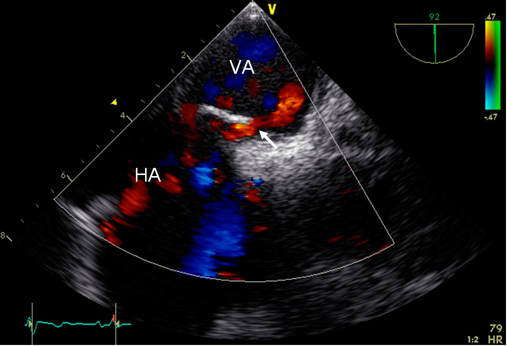 Figure 1  Transoesophageal echocardiogram with saline contrast two days after admission shows right-to-left shunt from right&hellip;