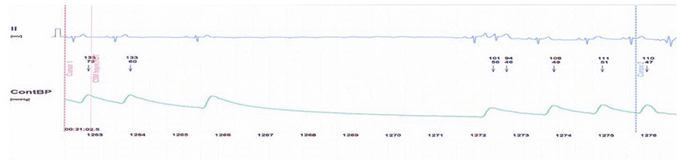 Figure 2  Print-out of ECG and blood pressure recording in our patient, showing bradycardia and a six-second sinus pause in&hellip;