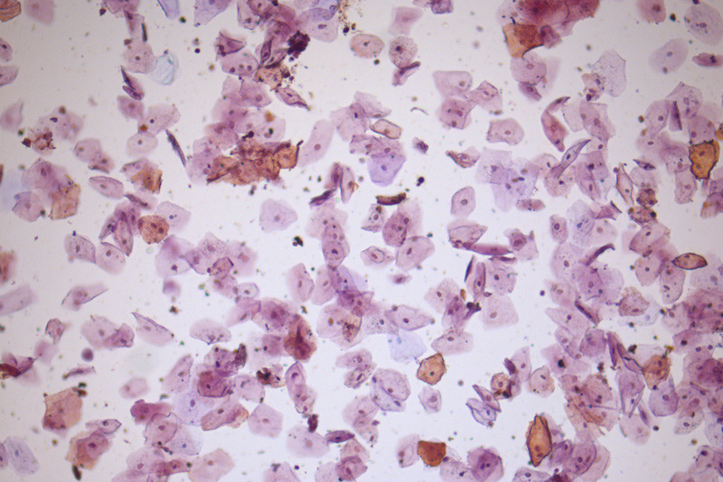 Figure 1  Urine sediment enlarged ten times shows abundant epithelial cells. These are cells from the genitalia and their&hellip;