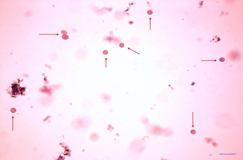 Figur 2  Urinsediment forst&oslash;rret 40 ganger viser mange intakte (isomorfe) erytrocytter. Dette er tegn p&aring; postglomerul&aelig;r&hellip;