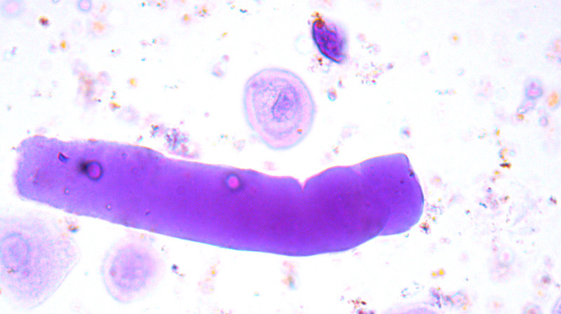 Figur 5  Urinsediment forst&oslash;rret 40 ganger viser en s&aring;kalt vokssylinder. Slike sylindre er oftest avst&oslash;pninger av de brede&hellip;