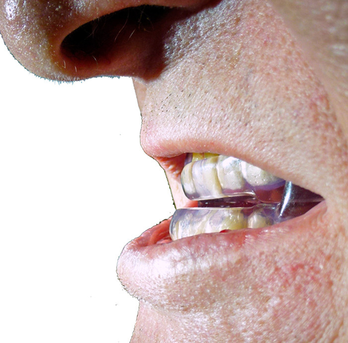 One of the most common types of oral appliances used in the treatment of sleep apnoea. Photo: private