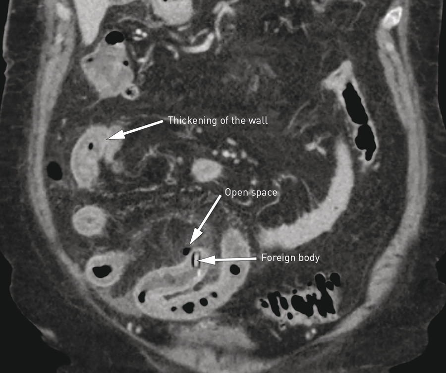 Figure 1  Abdominal CT scan shows perforation of the small intestine by a foreign body (tablet in blister pack) and&hellip;