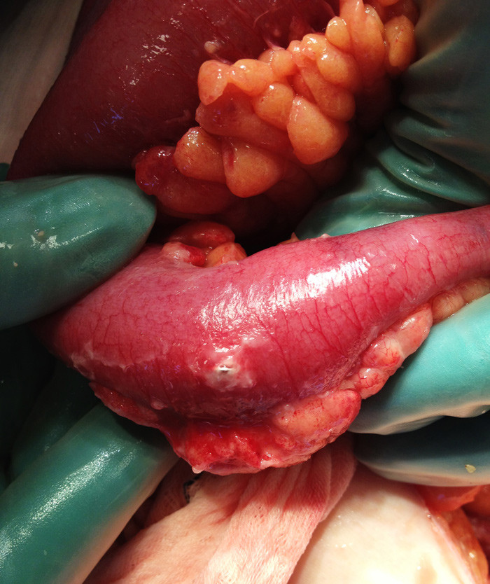 Figure 2  Photo of small intestine with blister pack protruding