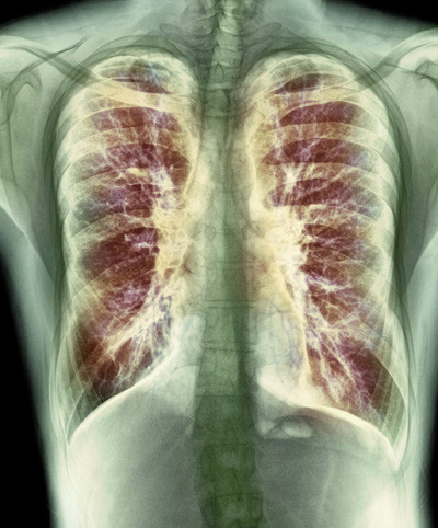 R&oslash;ntgenbilde av ung mann med cystisk fibrose. Illustrasjonsfoto: Sciencephoto/NTB scanpix