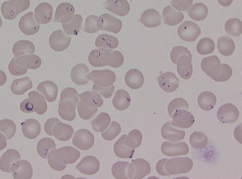 Figure 1  Thin smear showing high parasitaemia in patient with severe falciparum malaria. In such cases, rapid treatment&hellip;
