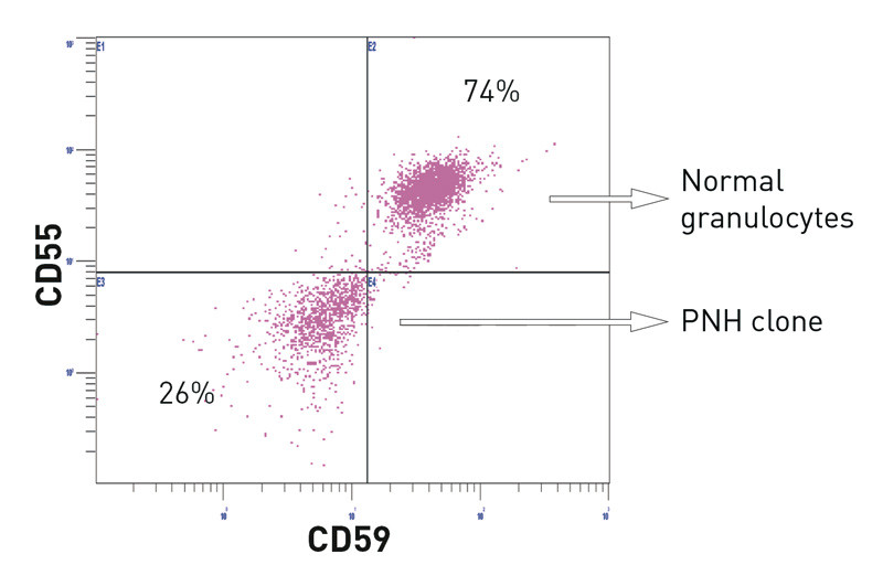 Figure 1  Example of flow cytometric analysis. Granulocytes that express neither CD59 nor CD55 make up the PNH clone, and&hellip;