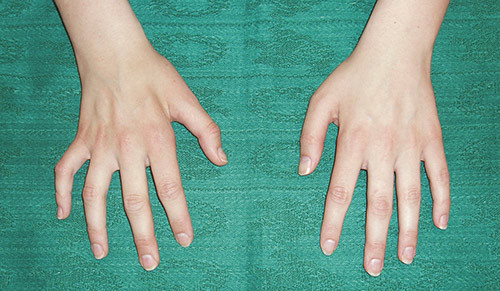 Figure 2  Marked atrophy of the small hand muscles, volar aspect