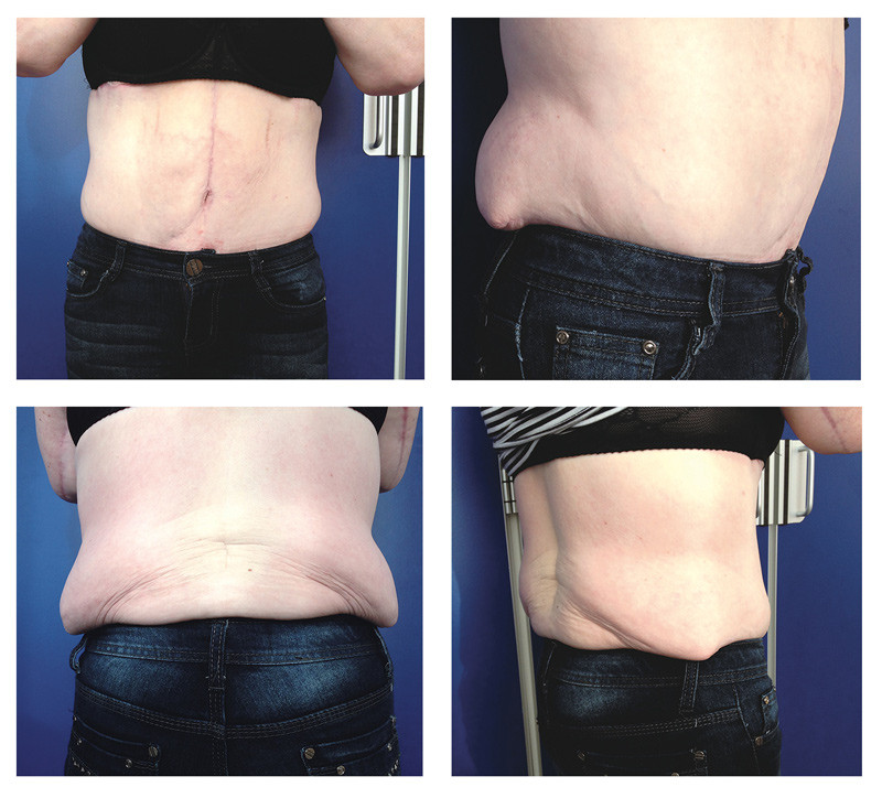 Figure 2  Poor outcome after abdominoplasty in a patient who should rather have had a lower body lift. This illustrates the&hellip;