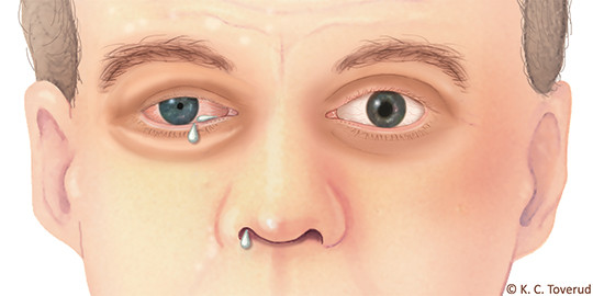 Figure 1  Cranial autonomic signs during a cluster headache attack. Partial Horner&rsquo;s syndrome (ptosis, miosis), conjunctival&hellip;