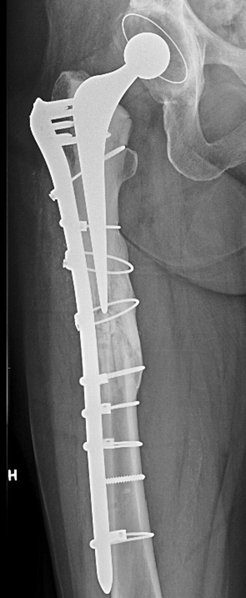 Figure 1  Consolidated fracture of the right femur, 31 months after the injury