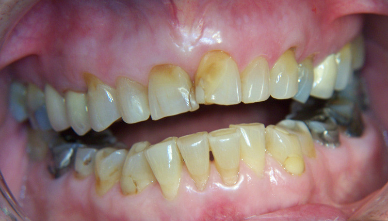 Figure 2  3.5 years after discontinuing alendronic acid. The patient now has contact only on her rearmost molars. Bite&hellip;