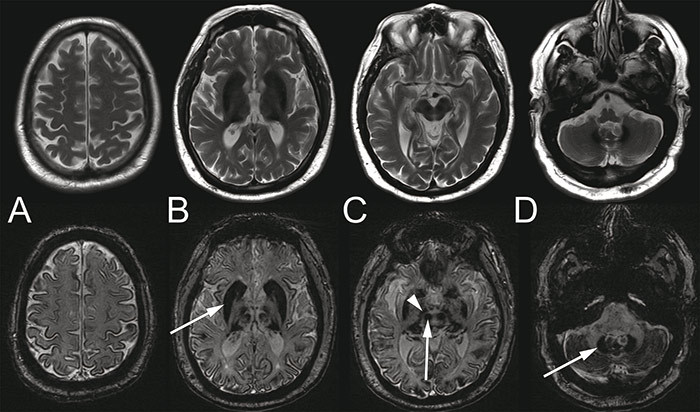 Figure 1  Cerebral MRI of the patient in his late 50s. T2-weighted (upper row) and susceptibility-weighted (SWI, bottom row)&hellip;