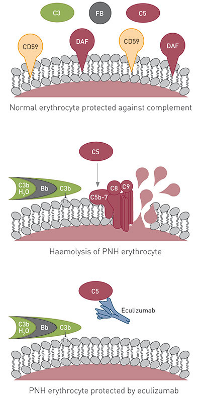 Figure 2  A schematic presentation of how eculizumab protects the erythrocyte against lysis in paroxysmal nocturnal&hellip;