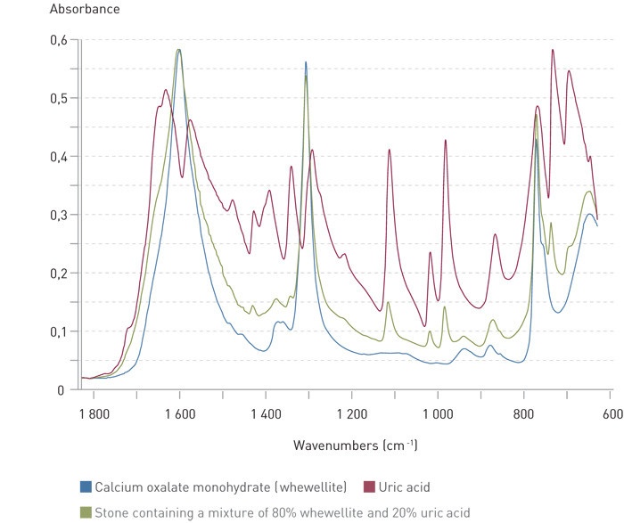 Figure 1  Exampels of infrared spectra of kidney stones. Blue: Pure calcium oxalate monohydrate (whewellite). Red: Pure uric&hellip;