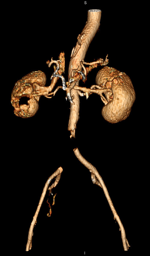 Figure 1  Three-dimensional CT angiography shows lack of contrast filling in distal abdominal aorta and right common iliac&hellip;