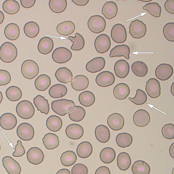 Figure 2  Blood smear with schistocytes (arrows)