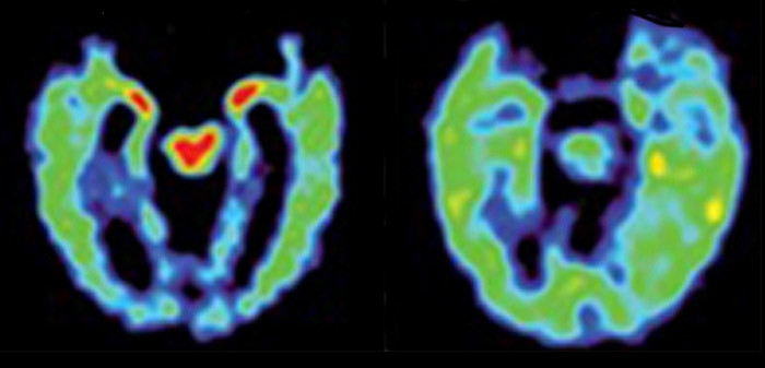 Hjerneskanning med positronemisjonstomografi. Til venstre: antatt traumatisk hjerneskade, til h&oslash;yre: Alzheimers sykdom. Foto&hellip;