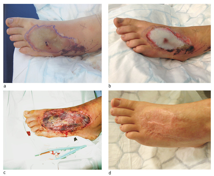 Figure 1  a) Twenty-four hours after extravasation of HyperHAES solution for infusion. b) One week post-injury. c) One week&hellip;