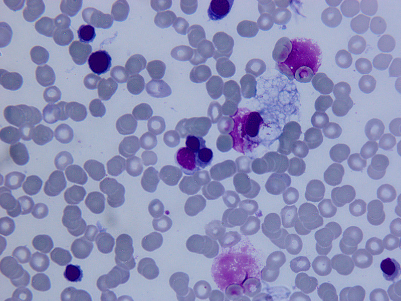 Figure 1  Light micrograph of bone marrow smear stained with May-Gr&uuml;nwald-Giemsa. Anisopoikilocytosis and abnormal&hellip;