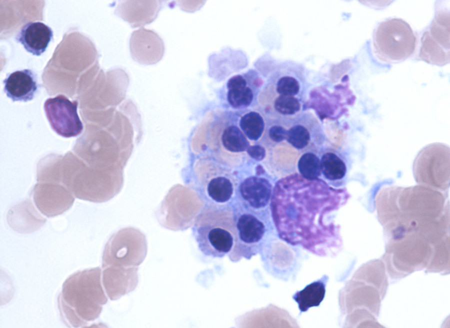 Figure 2  Magnified section of Figure 1 showing the patient&rsquo;s bone marrow aspirate