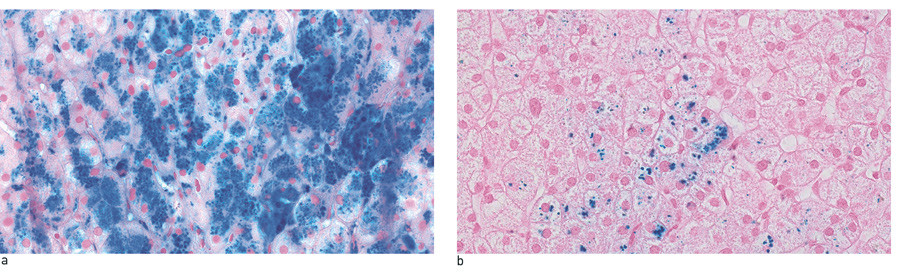 Figure 2  Liver biopsy from a man in his 50s with hereditary HFE haemochromatosis and homozygous for the C282Y mutation, a)&hellip;