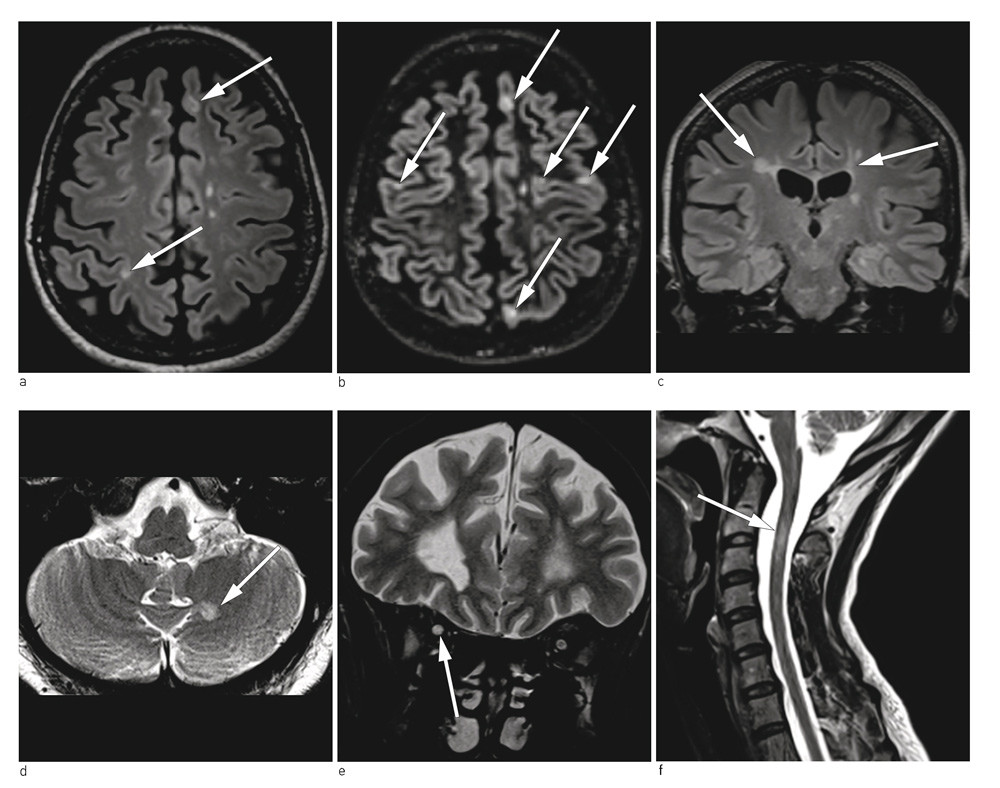 Figur 1  Lokalisering av typiske MS-lesjoner. Multippel sklerose-spesifikke lesjoner er lokalisert kortikalt/jukstakortikalt&hellip;