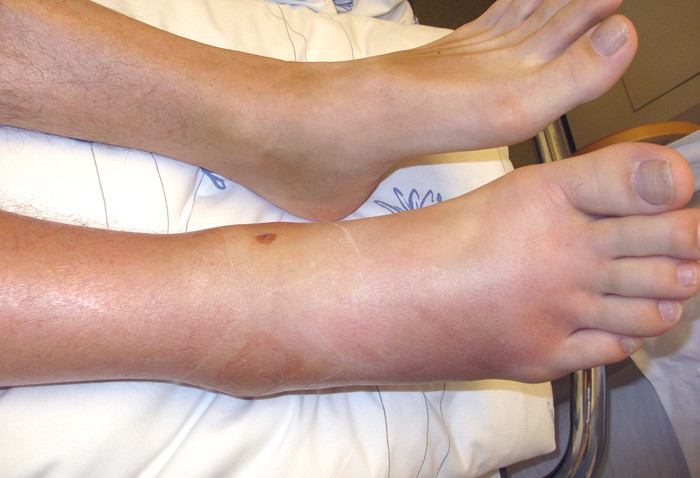 Figure 1  Right ankle upon admission. Photograph: Astrid Rykkje Heien