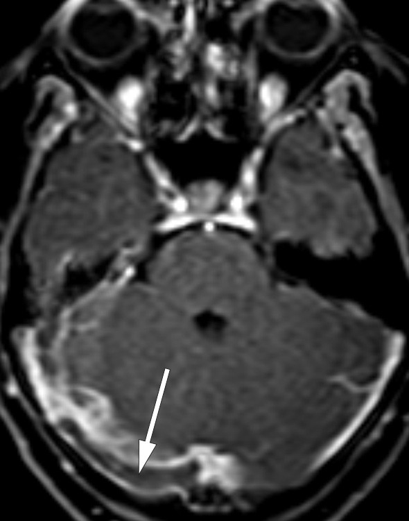 Figure 1  Thrombus in right transverse sinus (arrow) on T1-weighted MRI after contrast injection