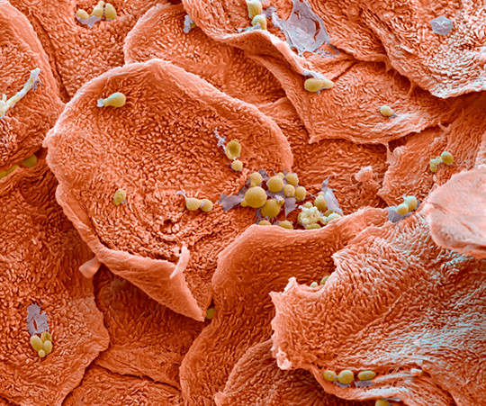 Farget elektronmikrografisk skanning (SEM) av psoriatiske hudceller. Foto: Science Photo Library