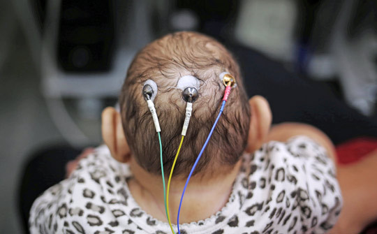 Et spedbarn med mikrokefali blir unders&oslash;kt ved et sykehus i S&atilde;o Paulo, Brasil. Foto: Reuters/NTB Scanpix
