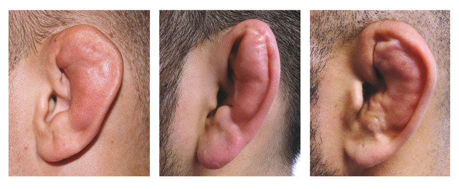 Figure 1  An untreated auricular haematoma can lead to cauliflower ear. Above, three patients with permanent and solid&hellip;