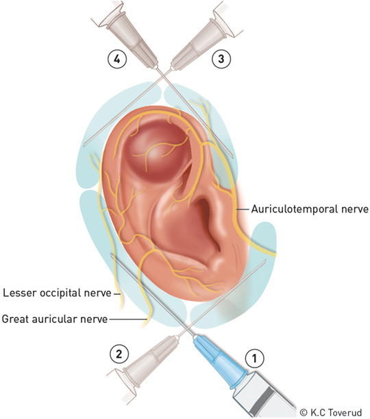 Figure 2  Regional auricular block is indicated for the evacuation of larger auricular haematomas. This provides good&hellip;
