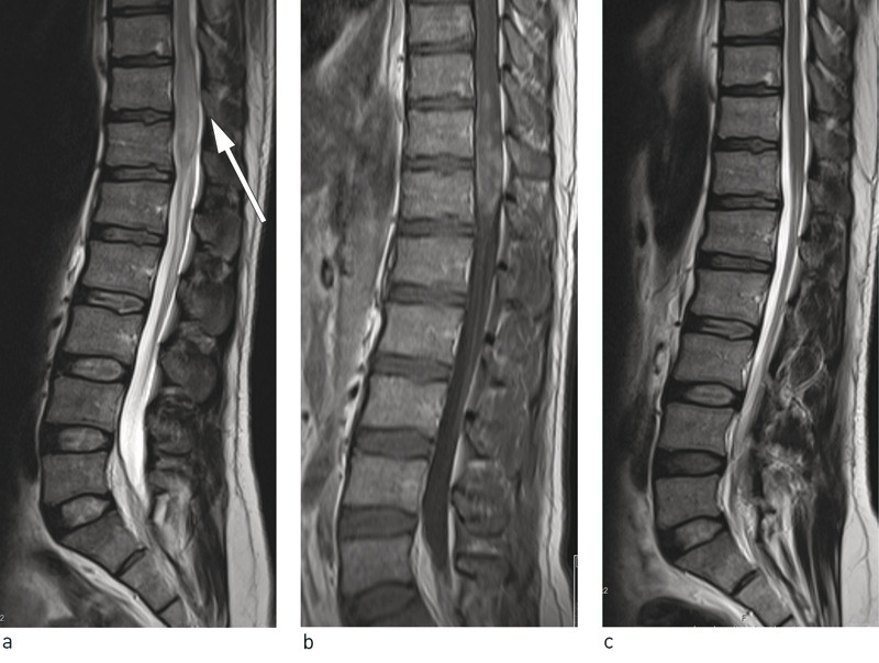 Figure 1  Lumbosacral spine MRI showing expansion of the medullary cone at level Th 11/Th 12 with hyperintensity on T2&hellip;