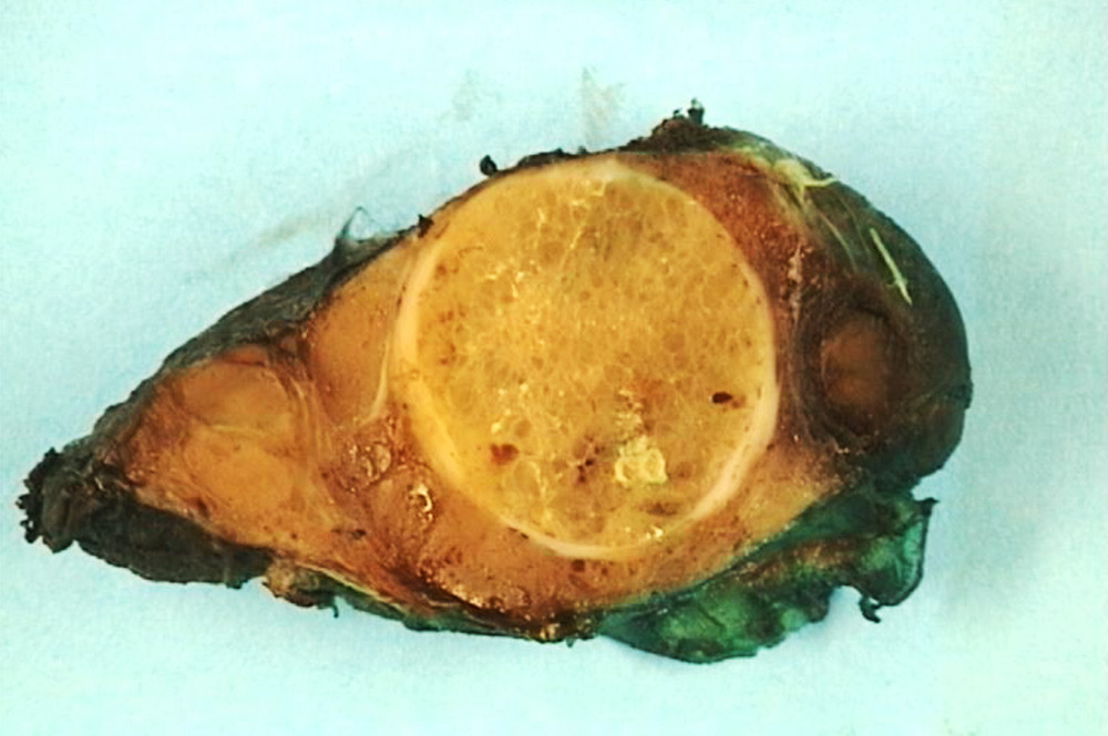Figure 1  Image (macroscopic) of left thyroid lobe with one large and several small nodules. Both photos: Krystyna Kotanska&hellip;