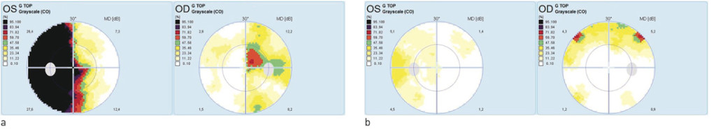 Figure 2  Threshold perimetry for right and left eye taken before and after the operation. The colour scale indicates&hellip;