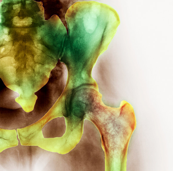 Nedsatt bentetthet hos kvinne i 40-&aring;rene. Foto: Science Photo Library