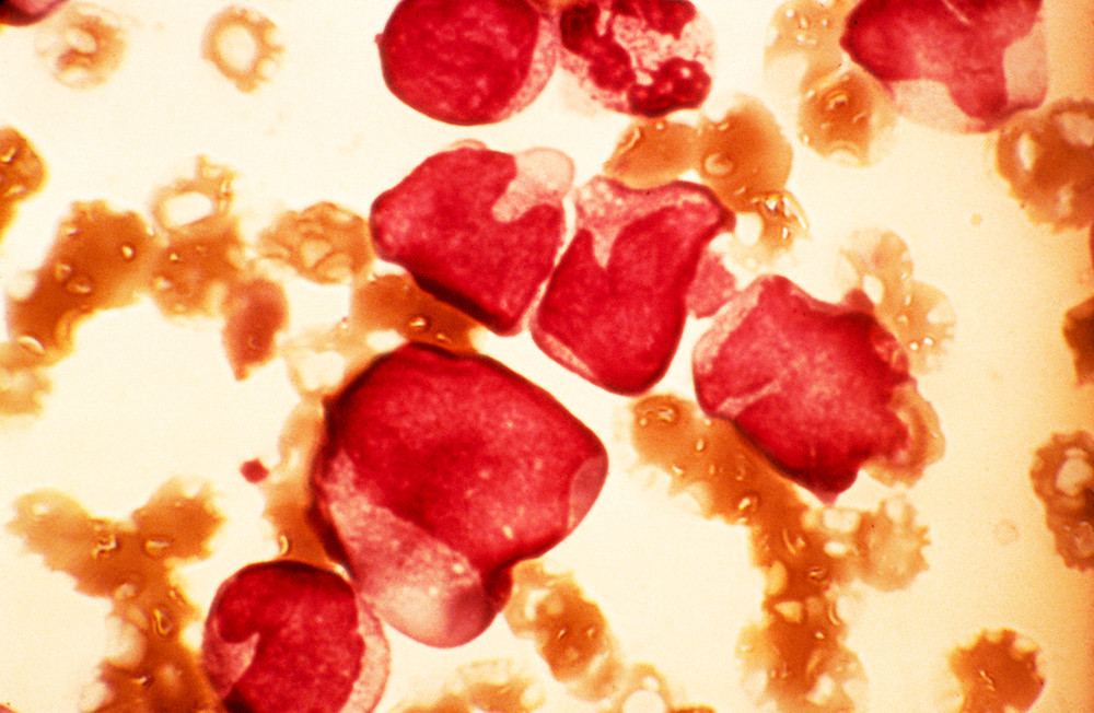Blodceller fra benmarg ved akutt myeloid leukemi. Foto: Science Photo Library