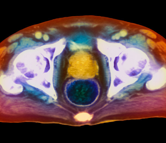 MR-unders&oslash;kelse av et aksialt (horisontalt) snitt gjennom en manns bekken viser kreft i prostatakjertelen (gult). Foto:&hellip;