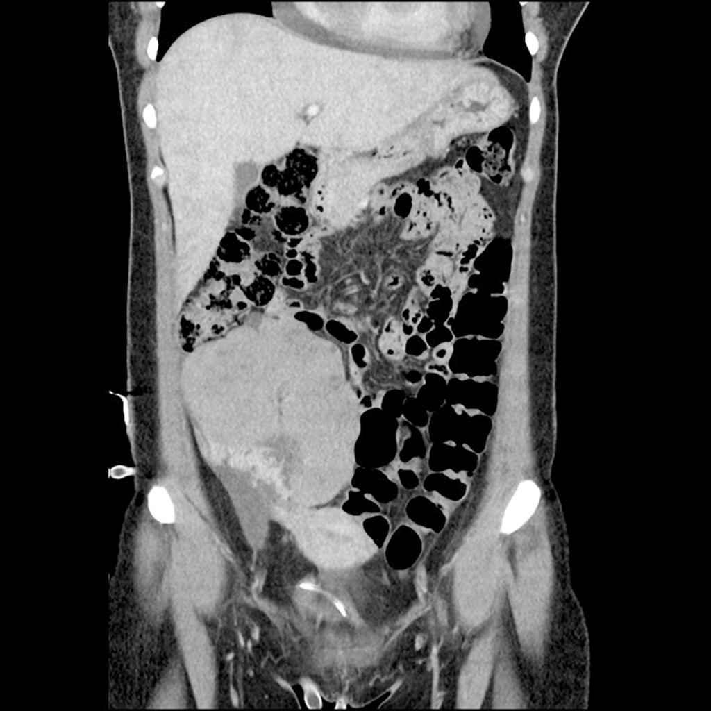 Figure 2 CT abdomen in the frontal plane at the time of diagnosis. A CT scan of the patient after hospitalisation revealed a&hellip;