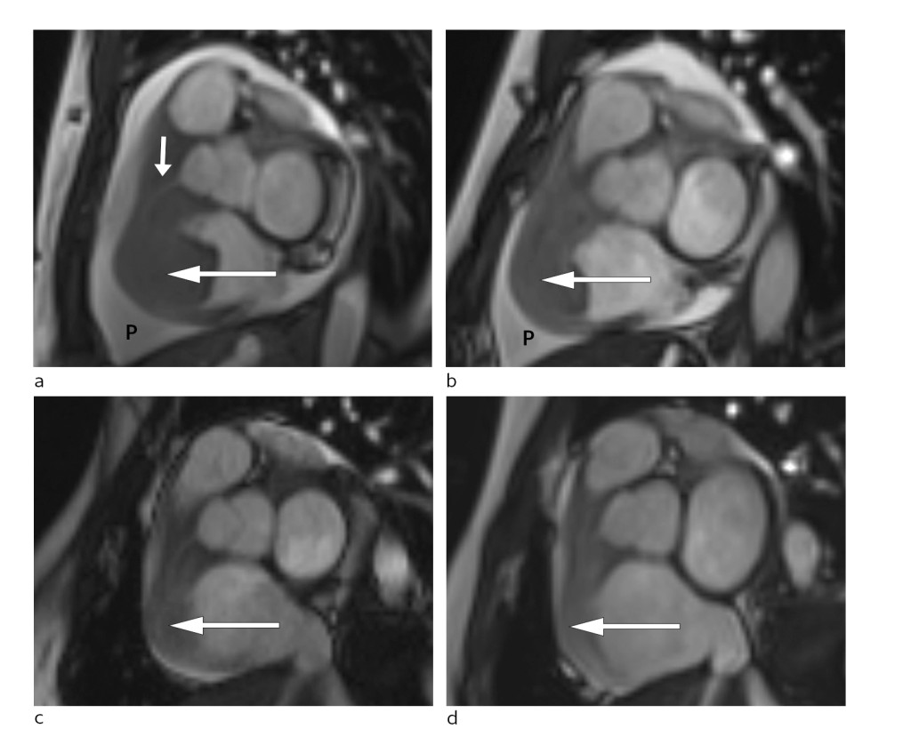 Figure 3 Short axis view of cardiac MRI at different disease stages. a) Large tumour at the time of diagnosis (large arrow)&hellip;