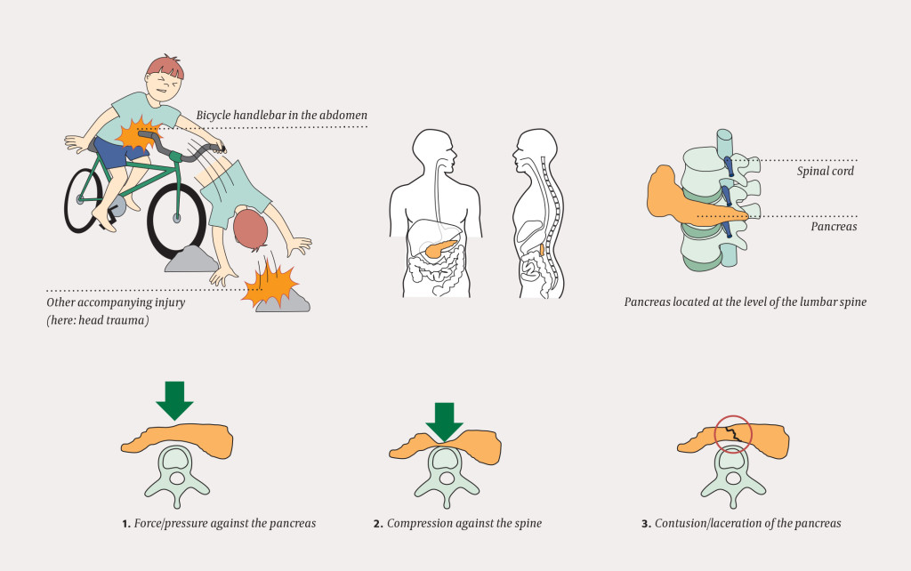 Figure 1 Pancreatic injury in children resulting from a bicycle handlebar accident. The pancreas is pressed against the&hellip;
