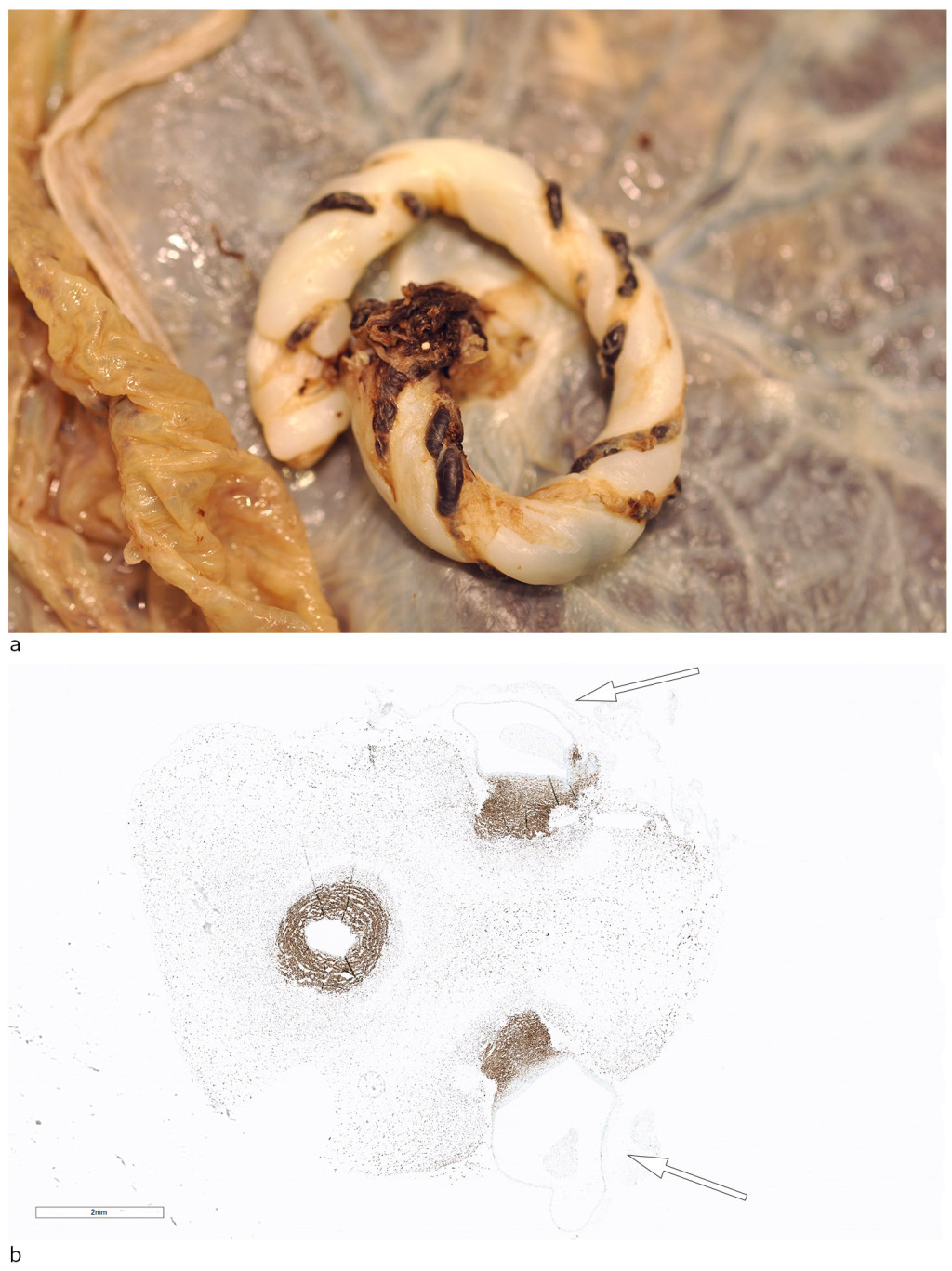 Figure 4 a) Cord after formalin fixation. B) Cord cross-section stained with the muscle marker desmin. Destruction of the&hellip;