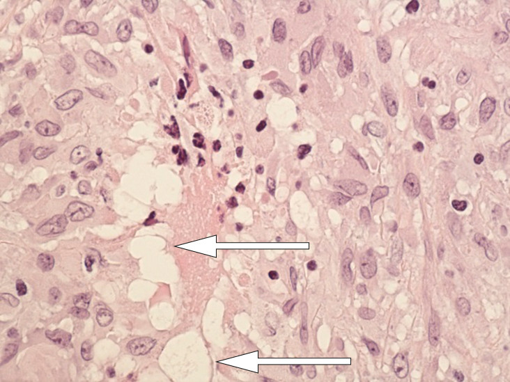 Figure 5 Section through implant capsule: close-up granuloma. There are changes in the macrophages in the form of hollow &hellip;