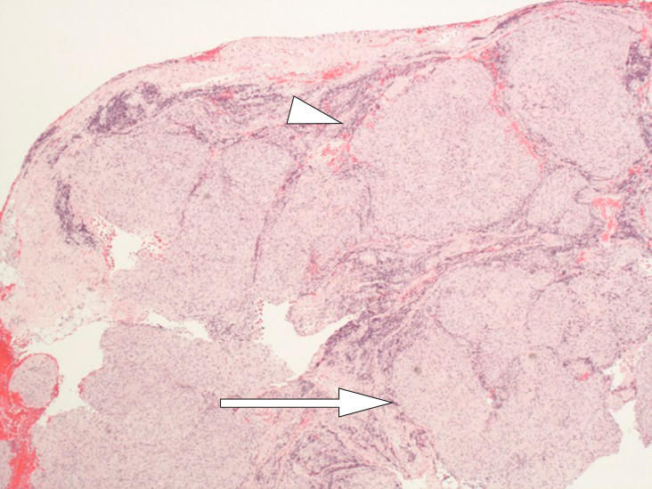 Figure 6 Lymph node with granulomatous inflammation: full of non-necrotising, well-formed epithelioid cell granulomas (arrow&hellip;