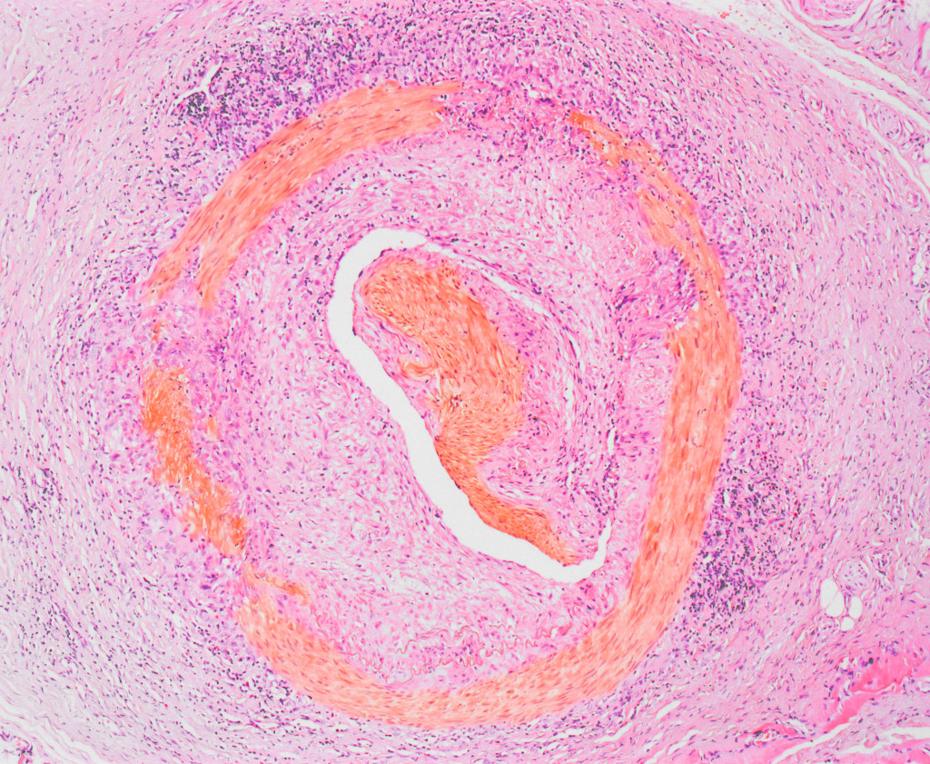 Kjempecellearteritt, mikrobilde av en del av et ber&oslash;rt kar. Illustrasjonsfoto: Science Photo Library