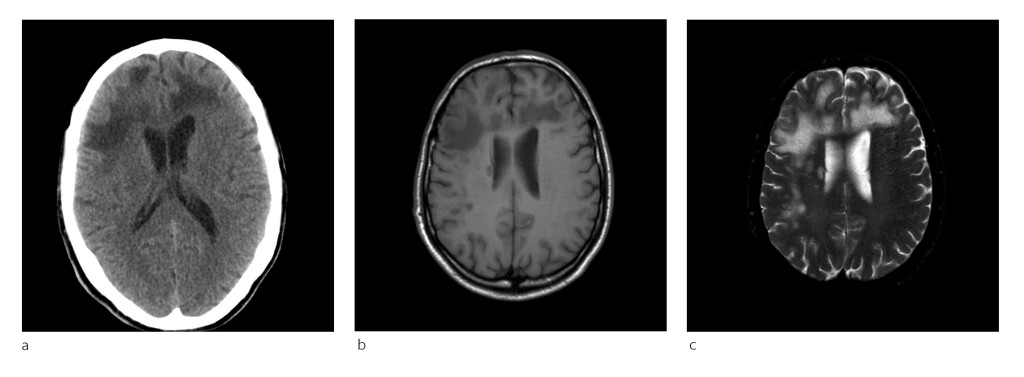 Figure 1 a) In patient 1, CT of the head showed bilateral non-specific confluent hypointensities in frontal subcortical&hellip;