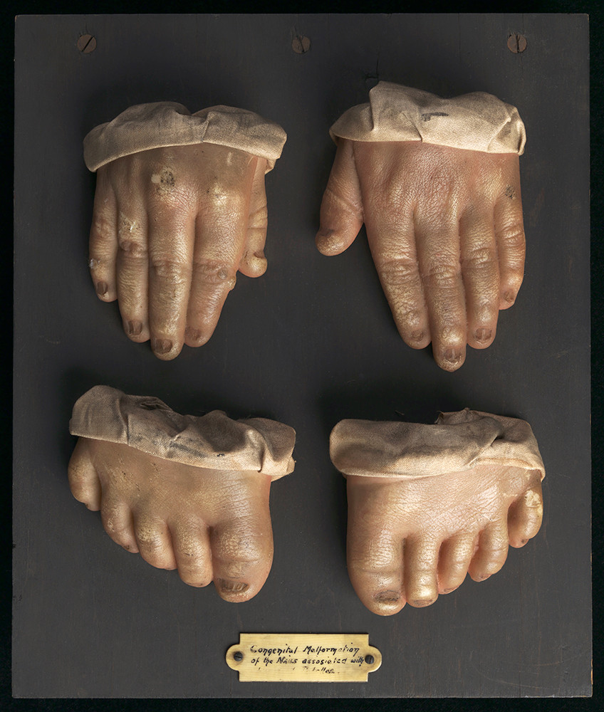 Voksavst&oslash;pninger har v&aelig;rt brukt som et sykdomsarkiv i undervisnings&oslash;yemed siden renessansen, og det finnes store historiske&hellip;